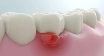 Gusi berdarah, gingivitis, periodontitis, scaling, kesehatan mulut