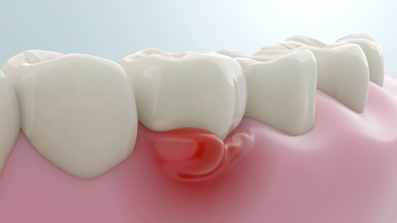 Gusi berdarah, gingivitis, periodontitis, scaling, kesehatan mulut